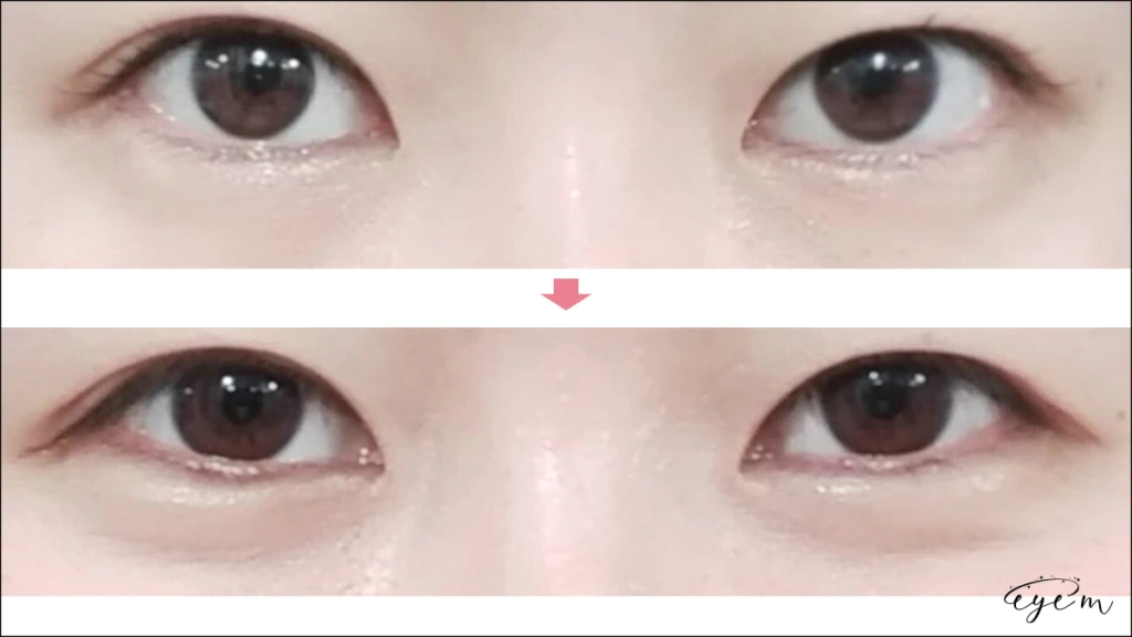 恵比寿美容外科の涙袋症例-eye'm読者提供