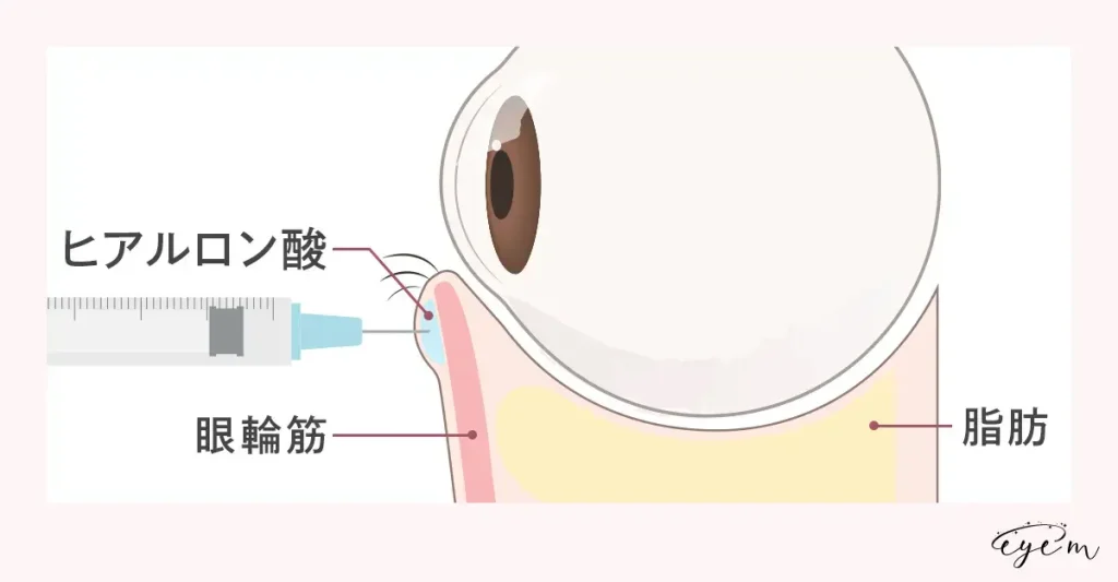 涙袋のヒアルロン酸注射の施術法