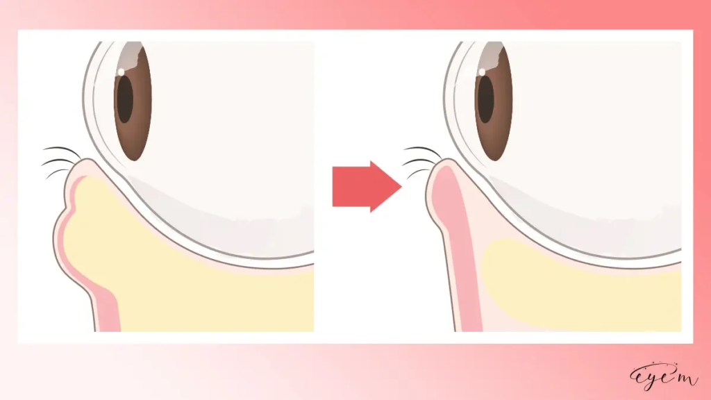 下瞼の脂肪が厚い目元のイラスト